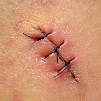 Heridas. Puntos de sutura
