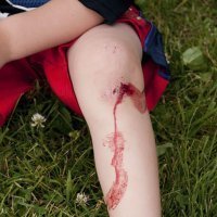 Heridas y quemaduras en los niños