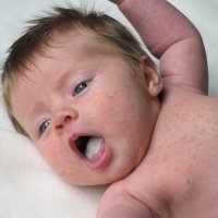 Los ungüentos con la vitamina d a la psoriasis el precio