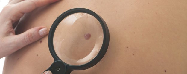 Lunares, cómo detectar si son malignos