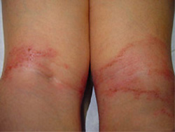 Dermatitis o eczema infantil