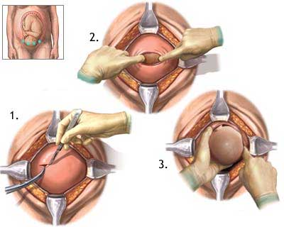 Parto del bebé Parto del bebé