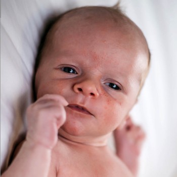 Causa y origen de la sudamina y acné neonatal en bebés recién nacidos