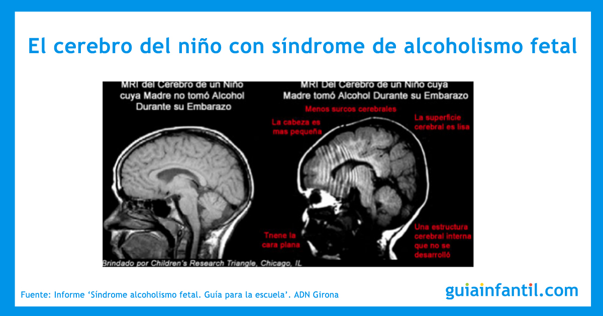 S Ndrome Del Alcoholismo Fetal