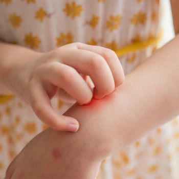 Enfermedades de piel en los niños por falta de higiene que se podrían evitar