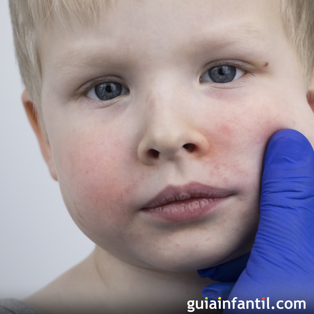Cuidar la piel de niños con pilar o granitos en las mejillas