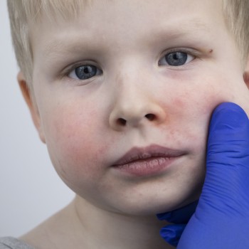 Cuidar la piel de niños con queratosis pilar o granitos en las mejillas