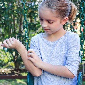 Relación de dermatitis atópica en niños con estrés, alergias y alimentación