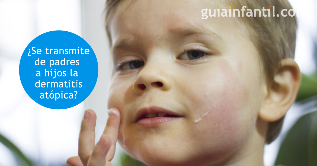 transmisión de la dermatitis atópica de padres a hijos