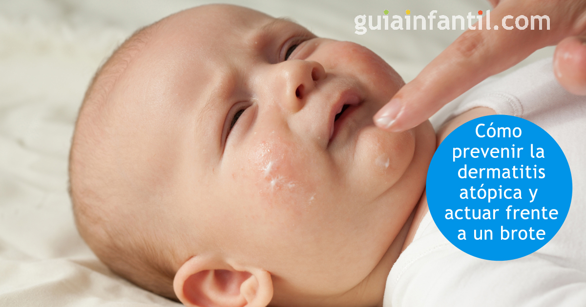 enfermedades de la piel en niños