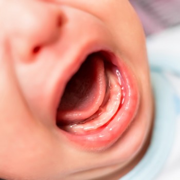 Dientes de leche o perlas de Epstein en recién nacidos y bebés