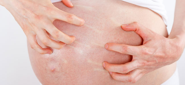 Prurigo o urticaria en el embarazo