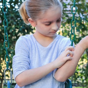 Señales que alertan de que tu hijo tiene alergia al látex