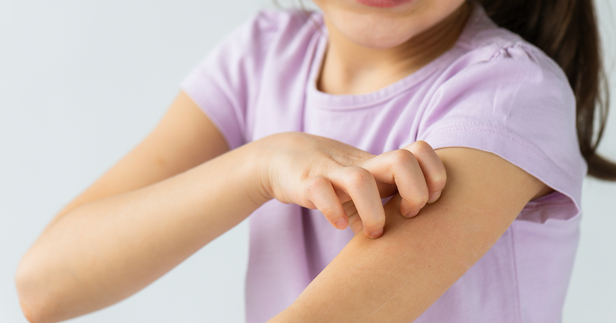 Brotes de dermatitis atópica en la vuelta al cole