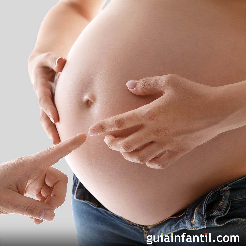 Hernia umbilical y embarazo