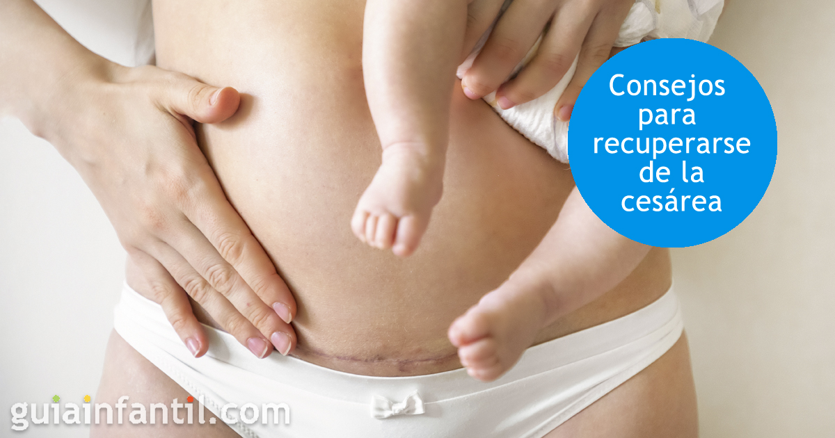 La cesárea en el parto. Cómo recuperarse de una cesárea