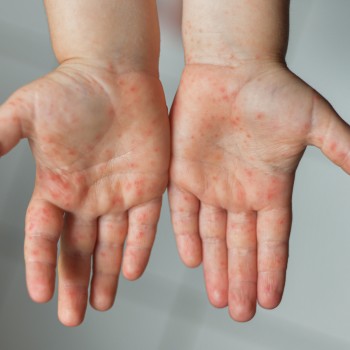 Viruela del mono en niños y embarazadas. Importantes medidas de prevención