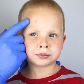 Cáncer de piel en los niños - Cómo reconocer el melanoma