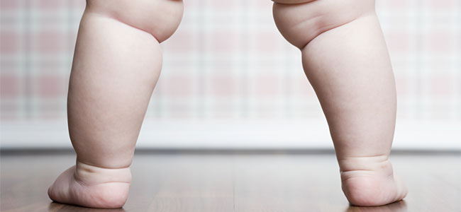 Pies planos y obesidad Pies planos y obesidad