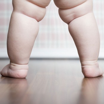 Pies planos y obesidad infantil