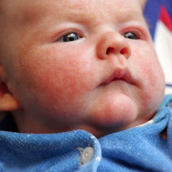 Guía práctica para controlar la dermatitis atópica en bebés y niños