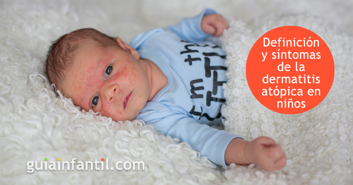 Síntomas de la dermatitis atópica en niños y bebés