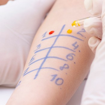 Exámenes de alergia en los niños - ¿Cómo saber si mi hijo es alérgico?