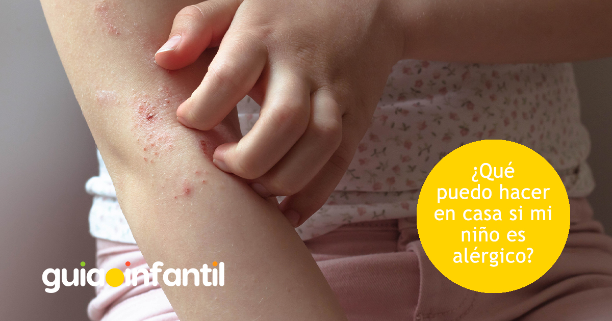 Qué hacer en casa si el niño es alérgico