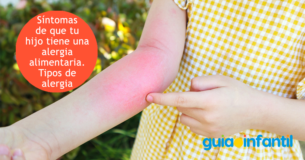 Síntomas de alergia alimentaria en niños
