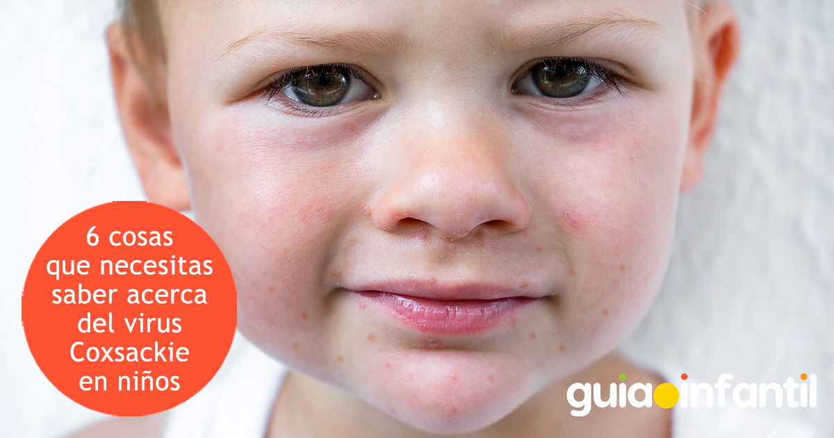 Coxsackie en niños