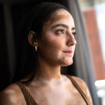 El impacto psicológico del vitiligo en el embarazo - ¿Afecta al bebé?