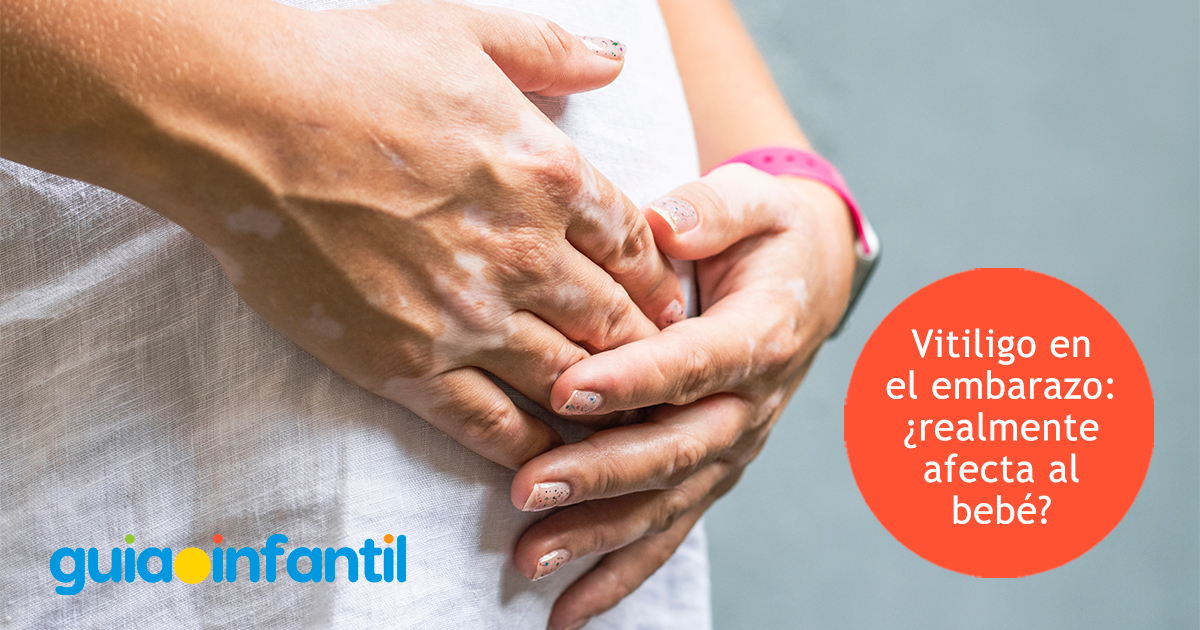Embarazo y vitiligo