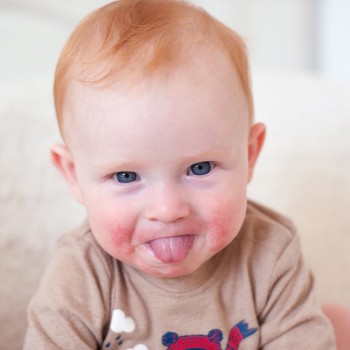 Terapias novedosas y eficaces contra la dermatitis y psoriasis infantil