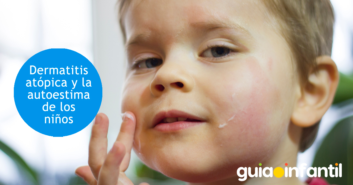 La autoestima de los niños y la dermatitis atópica