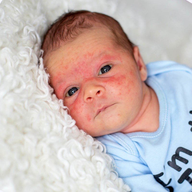 Identifica fácil los distintos tipos de manchas en la piel de los niños