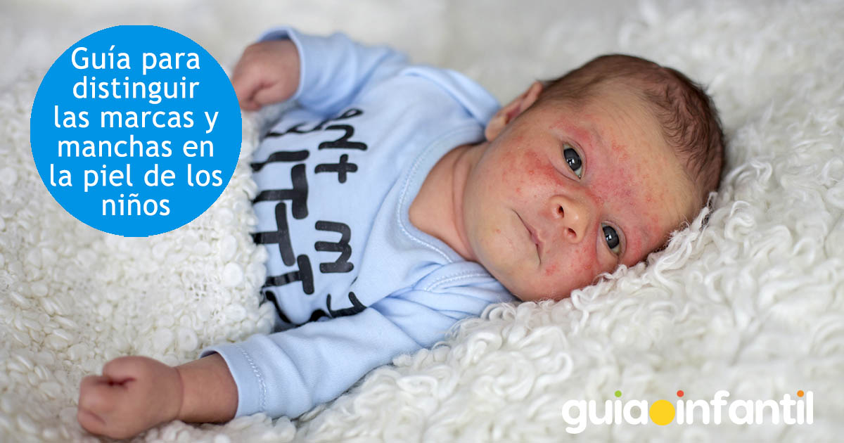 Manchas en la piel de los niños