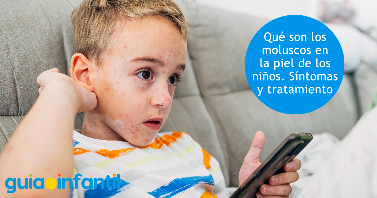 Los moluscos en los niños