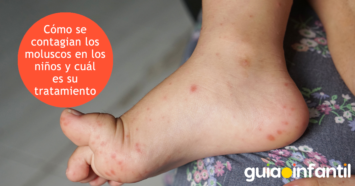 Contagio de la piel con moluscos