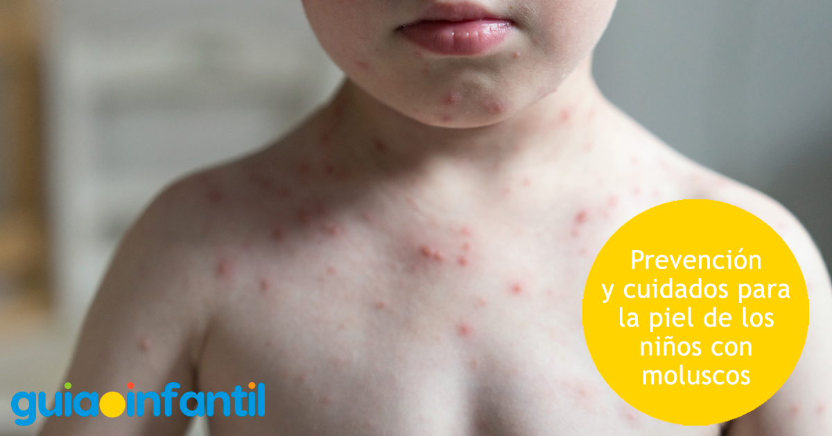 Prevención de los niños con moluscos