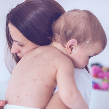 Herpes zóster en niños. 5 preguntas sobre el virus de la culebrilla