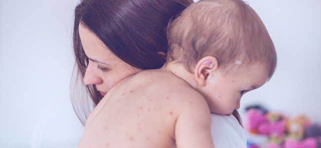 el herpes zóster en niños