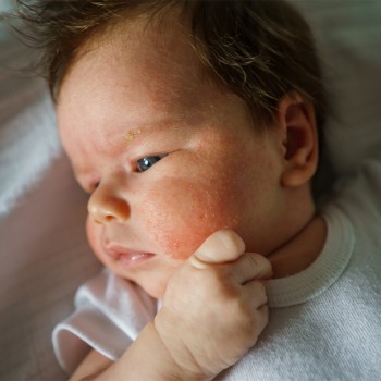 ¿Cuáles son los jabones adecuados para niños con dermatitis atópica?