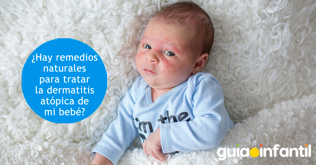 Remedios para la dermatitis atópica