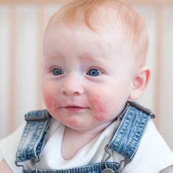 ¿Qué ropa le puedo poner a mi bebé si tiene dermatitis atópica?