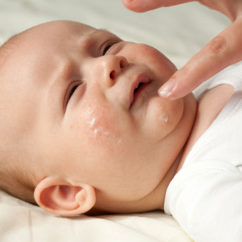 Niños con alergias en la piel - Cómo identificar una reacción alérgica
