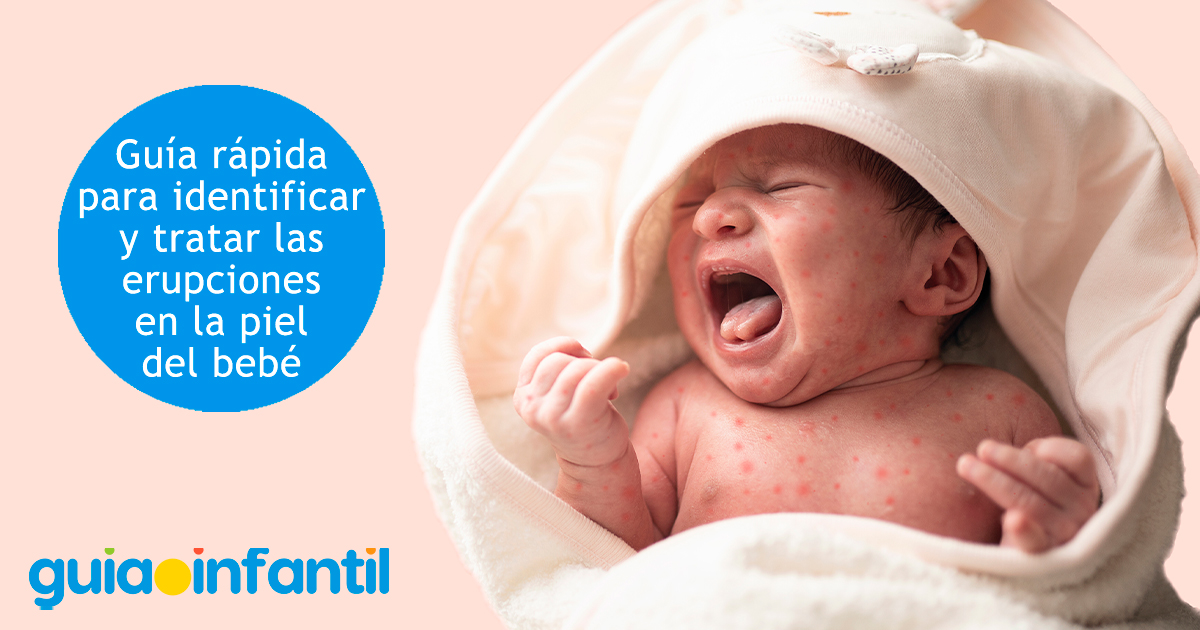 Guía de infecciones para la piel del bebé