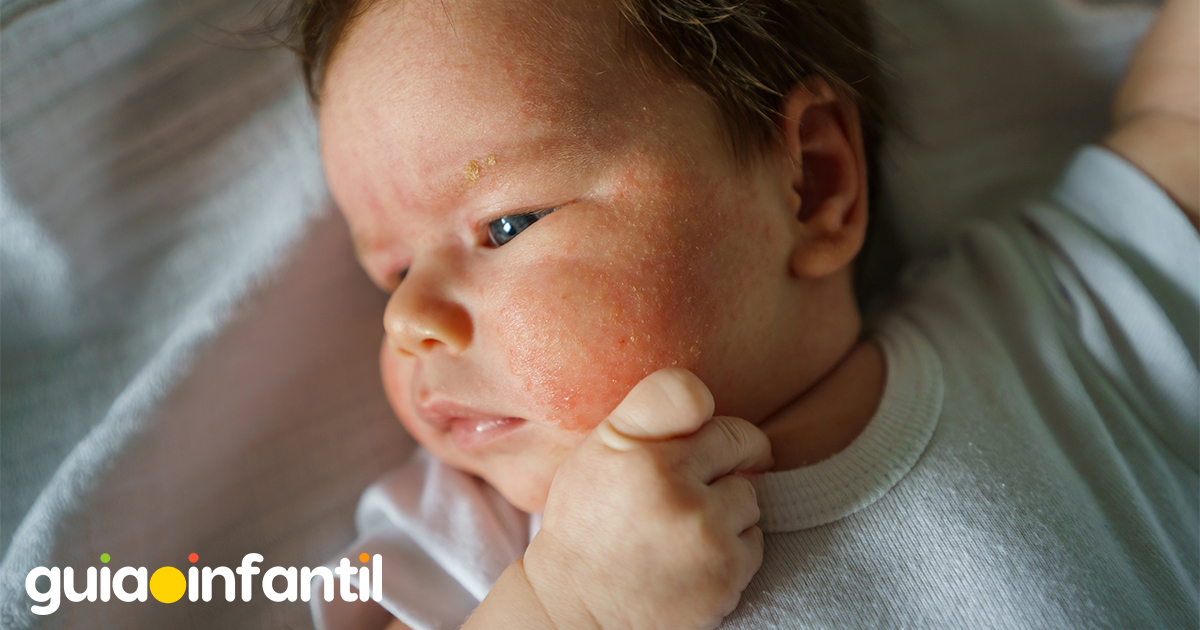 Sudamina en la piel de los bebés