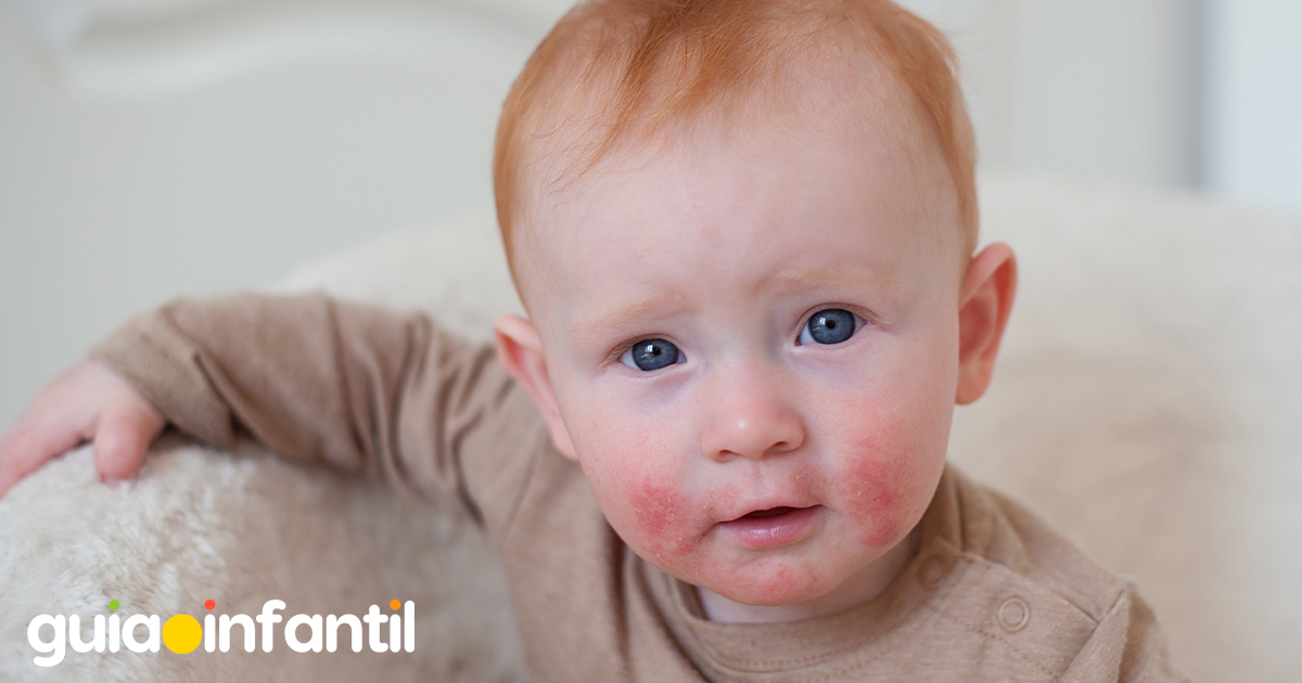 Varicela en la piel de los niños