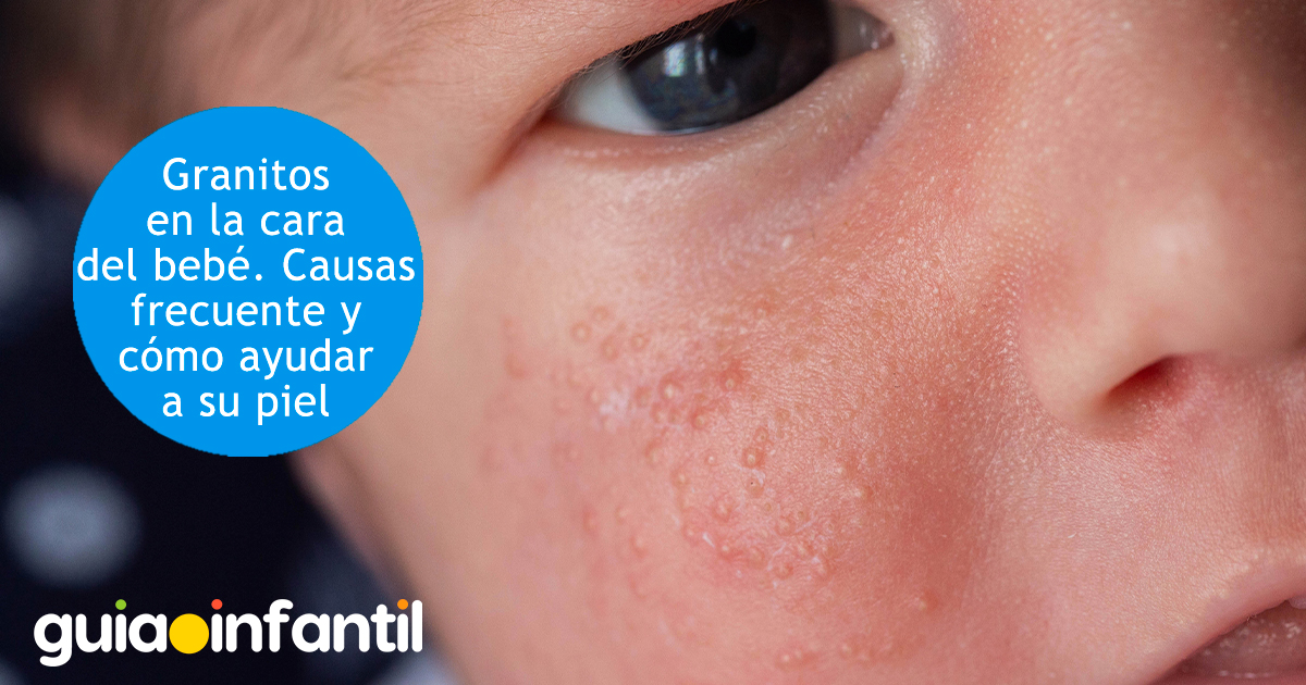 Granitos en la cara del bebé