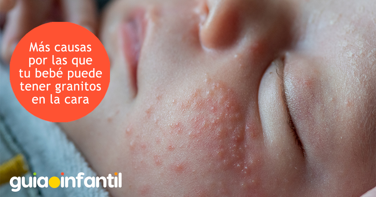 Causas de los granitos en la cara del bebé